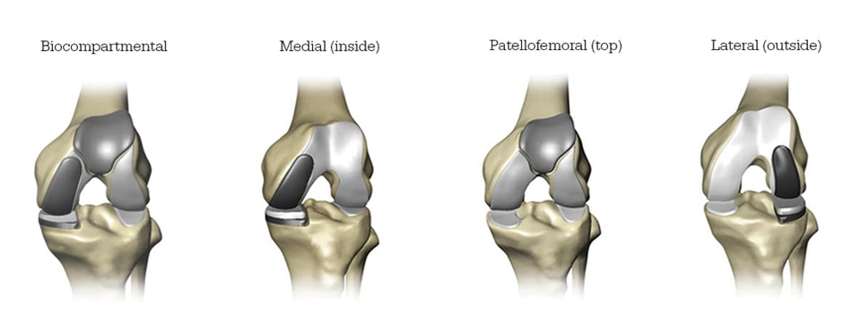 Partial Knee Replacement