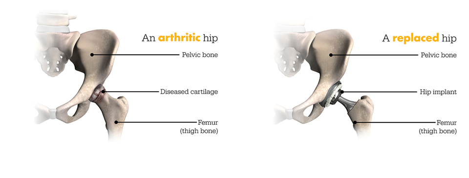 Total Hip Replacement