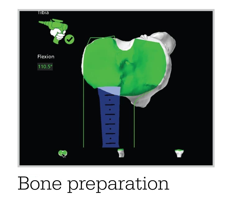 Total Knee Replacement