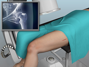 Direct Anterior Hip Replacement