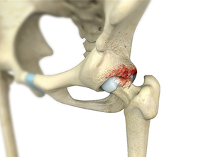 Normal Anatomy of the Hip Joint