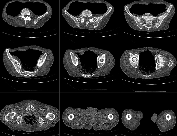 Mako Robotic-Arm Assisted Technology for Total Hip Replacement