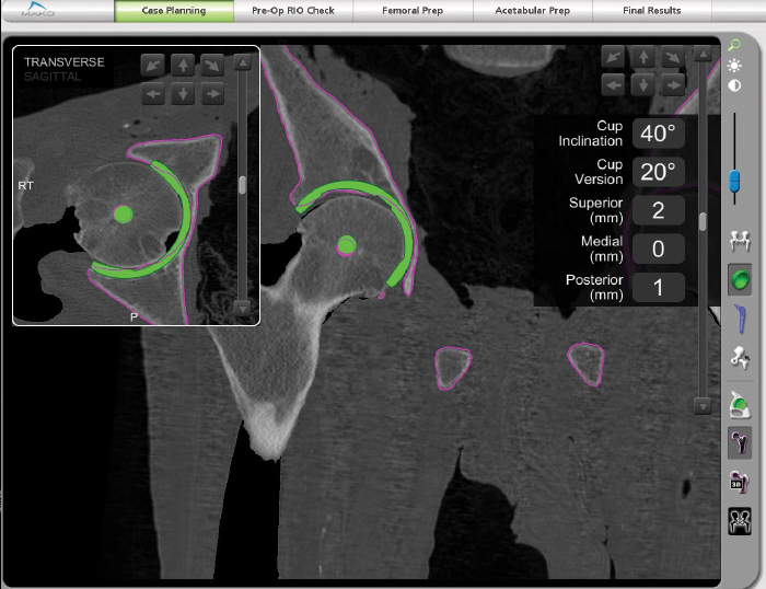 Mako Robotic-Arm Assisted Technology for Total Hip Replacement