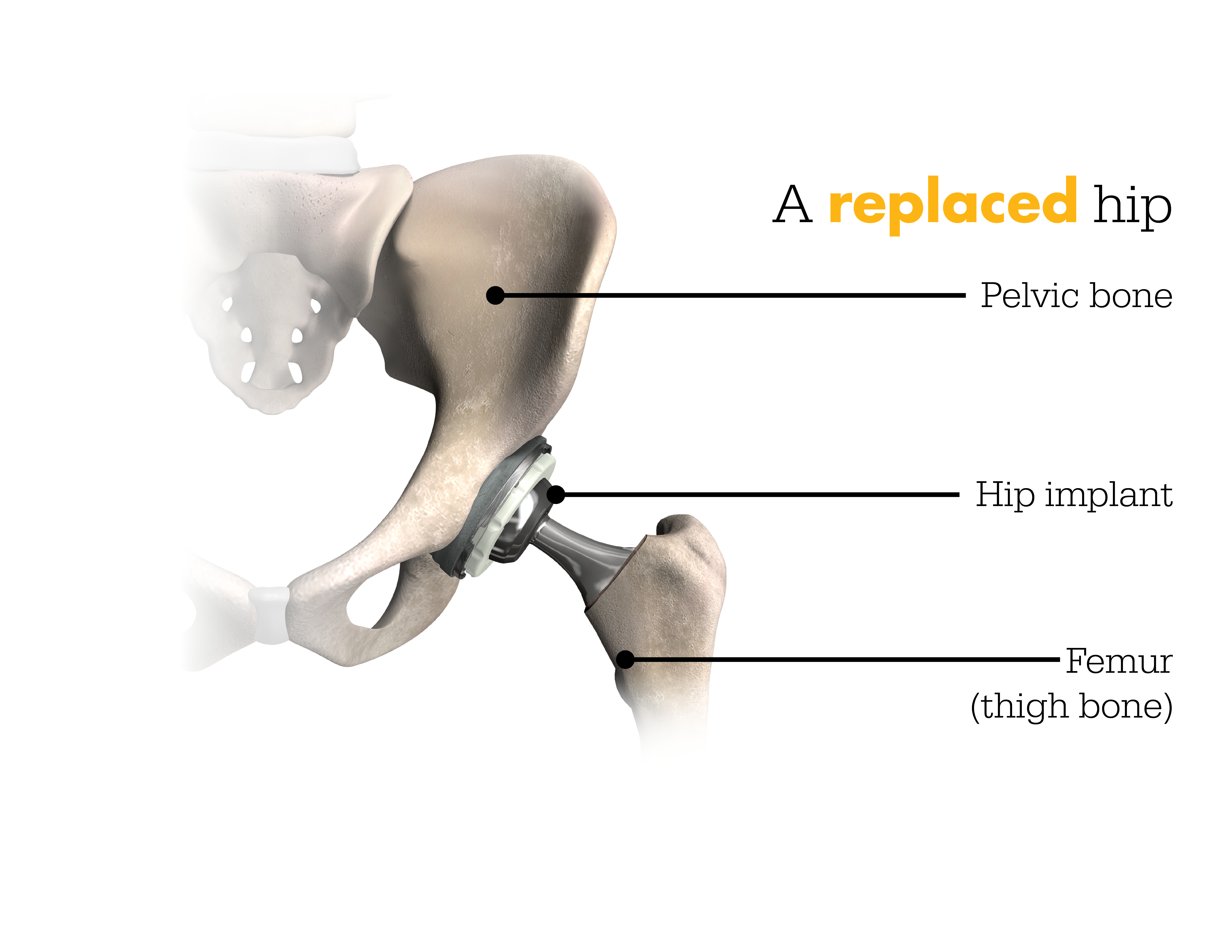 Mako Robotic-Arm Assisted Technology for Total Hip Replacement