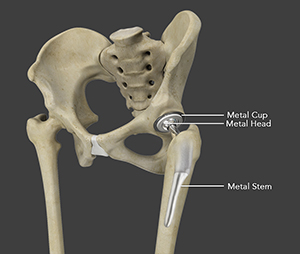 Total Hip Replacement (THR)