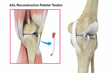 ACL Reconstruction Patellar Tendon