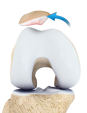 Patellofemoral Instability