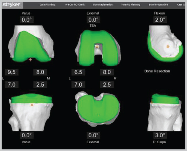 Personalized Pre-operative Plan